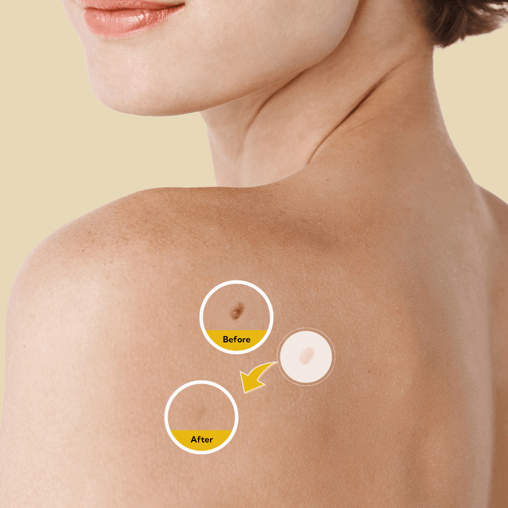 TagX - Advanced 9 Level Skin Tag Remover Pen