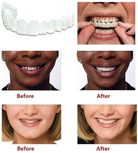 Snap on Smile Veneers - Smilo™