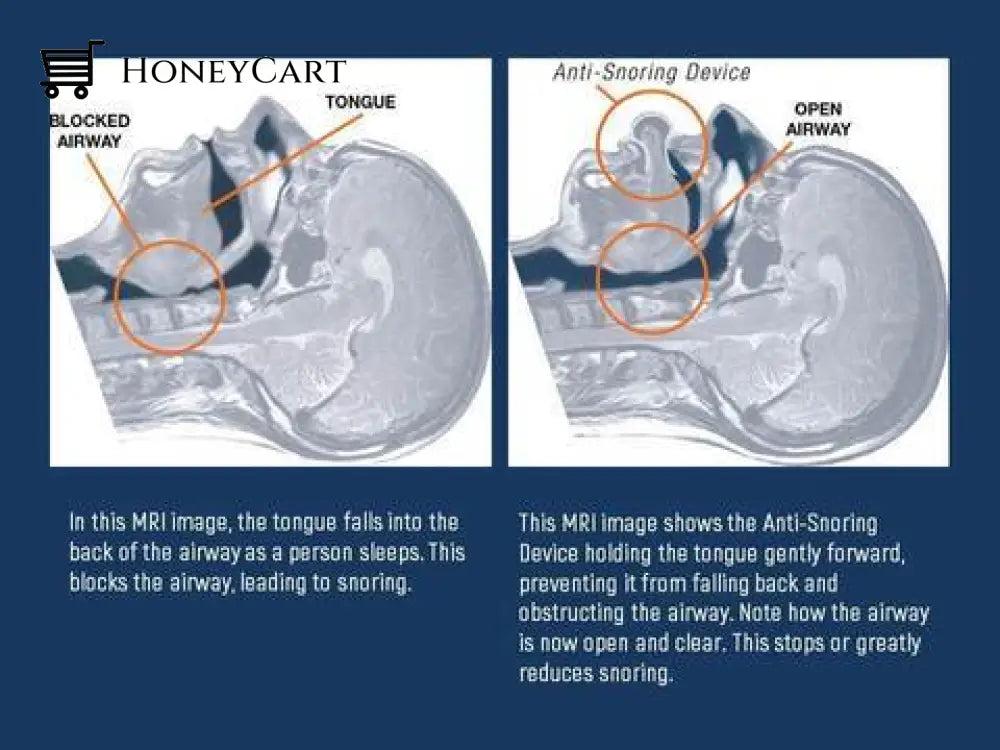 Apnea Tongue Stabilizing Device