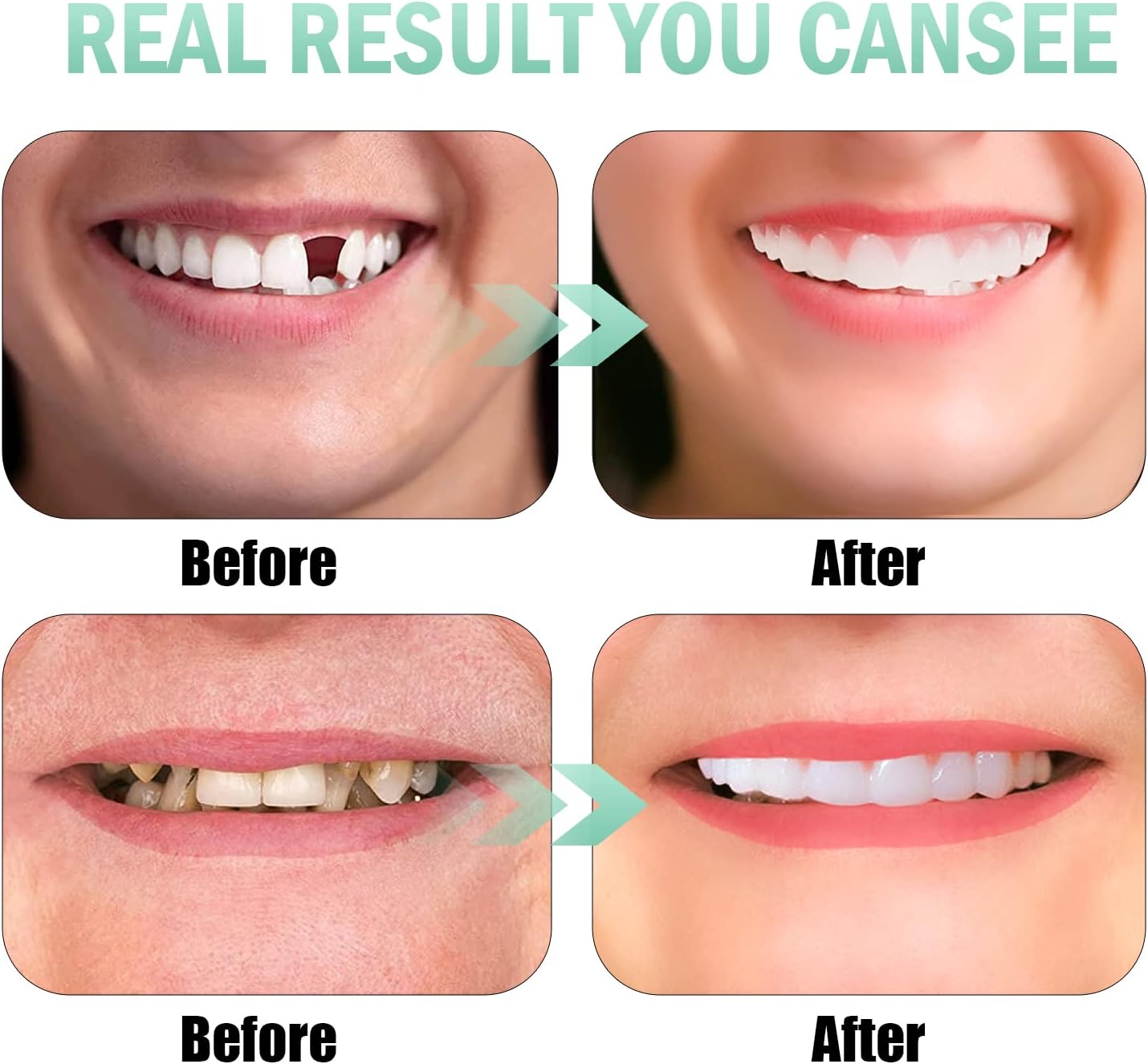 Teeth veneers Instant Cosmetic Veneers (Upper & Lower)