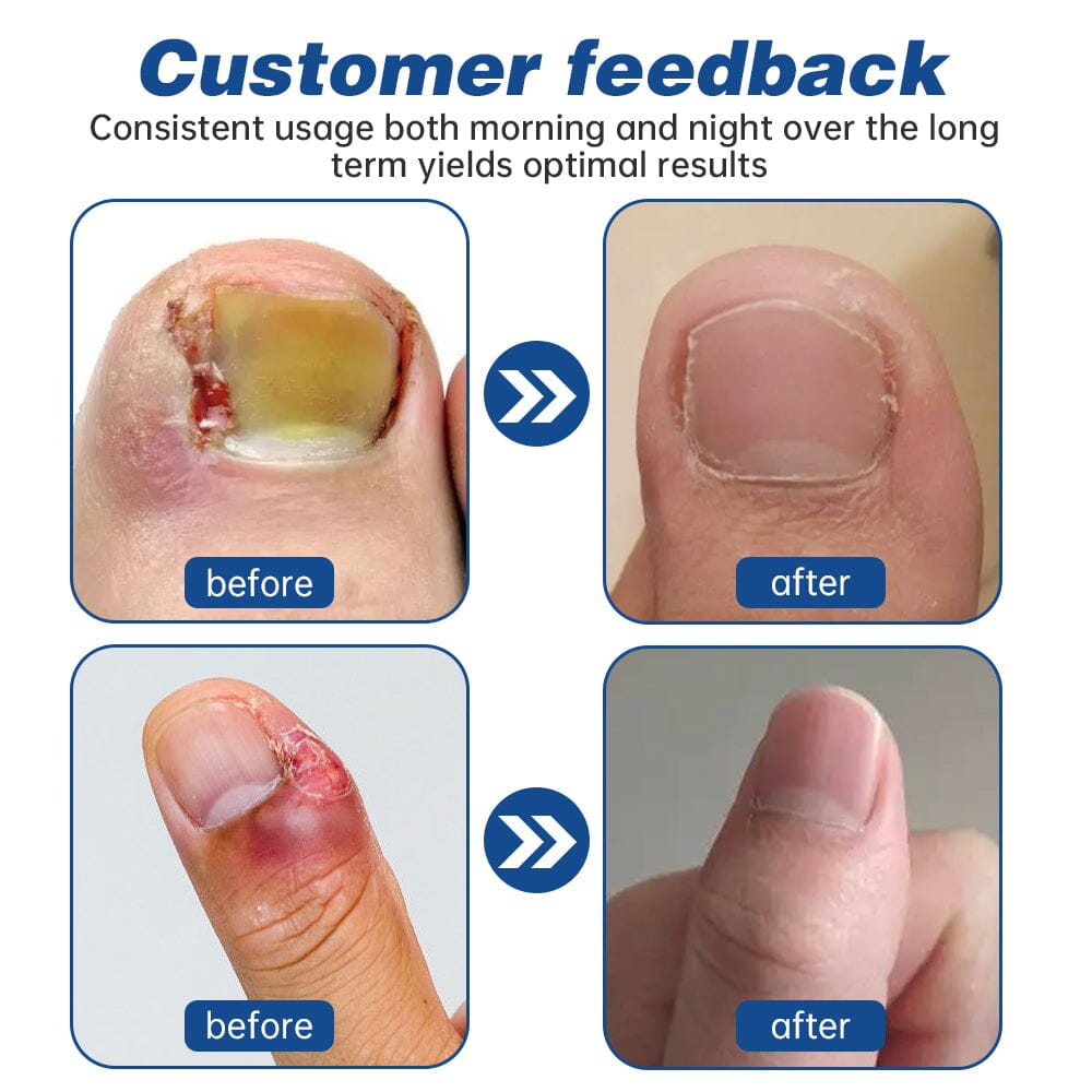 Furzero™ Herbal Formula Fungal nail Paronychia treatment Gel