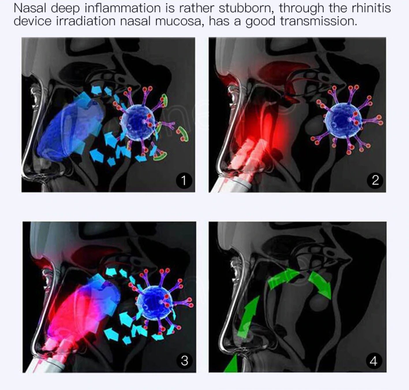 Infrared Rhinitis Therapy Device