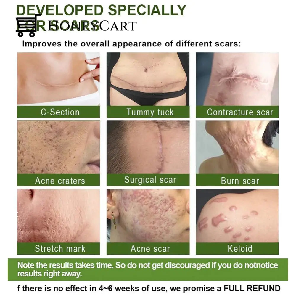 Advanced Scar Repair Serum For All Types Of Scars - Especially Acne Surgical And Stretch Marks