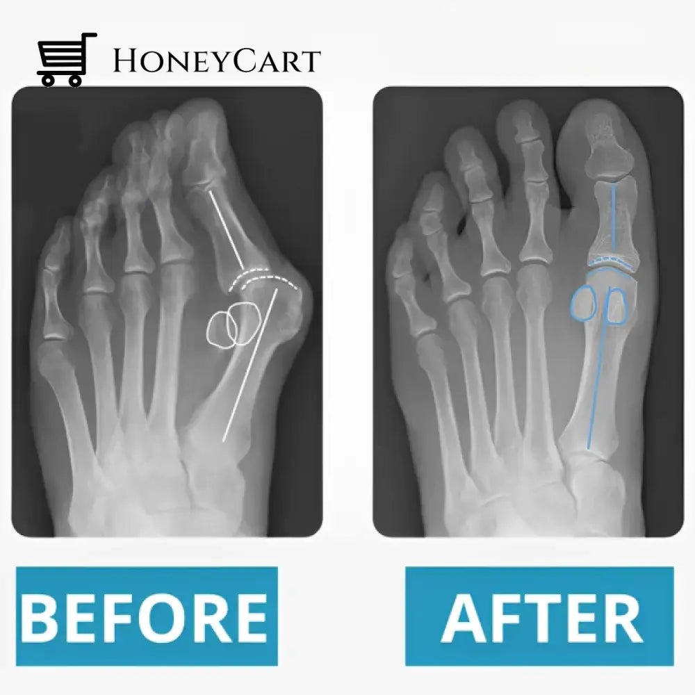 Bunion Corrective Toe Socks Tool