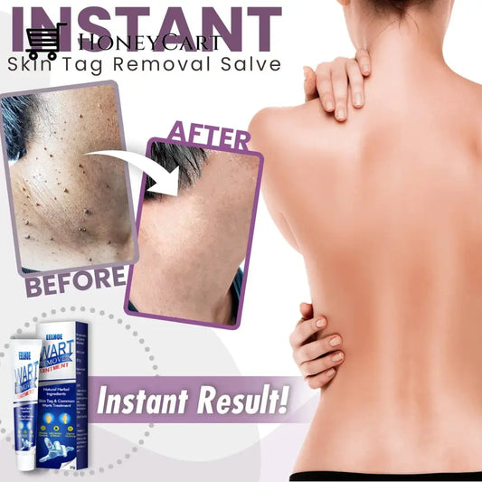 Instant Skin Tag Removal Salve