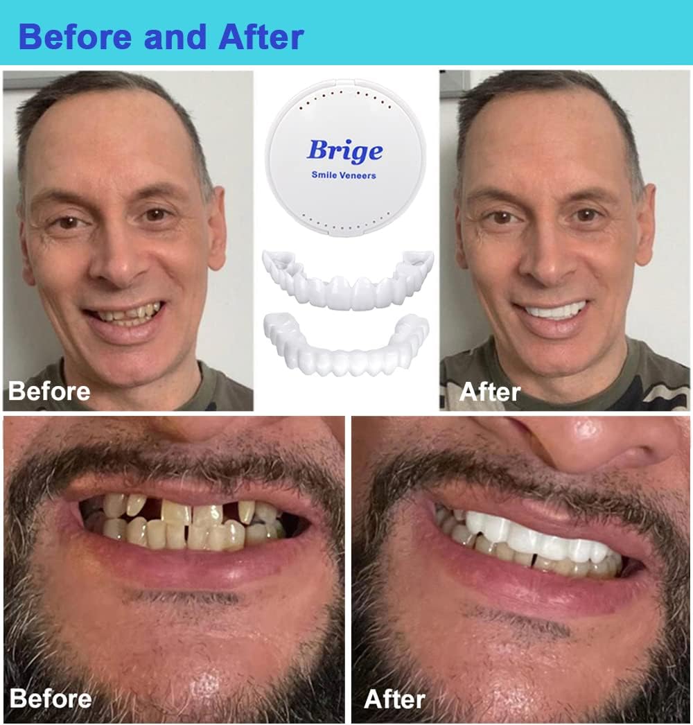 Teeth veneers Instant Cosmetic Veneers (Upper & Lower)